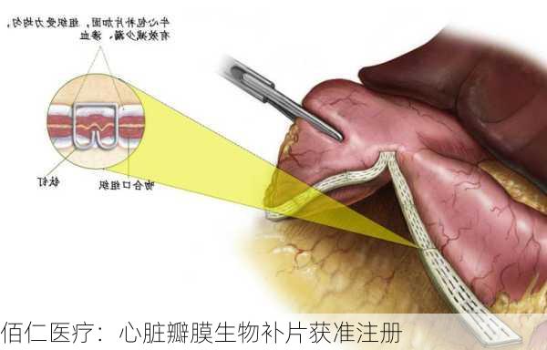 佰仁医疗：心脏瓣膜生物补片获准注册